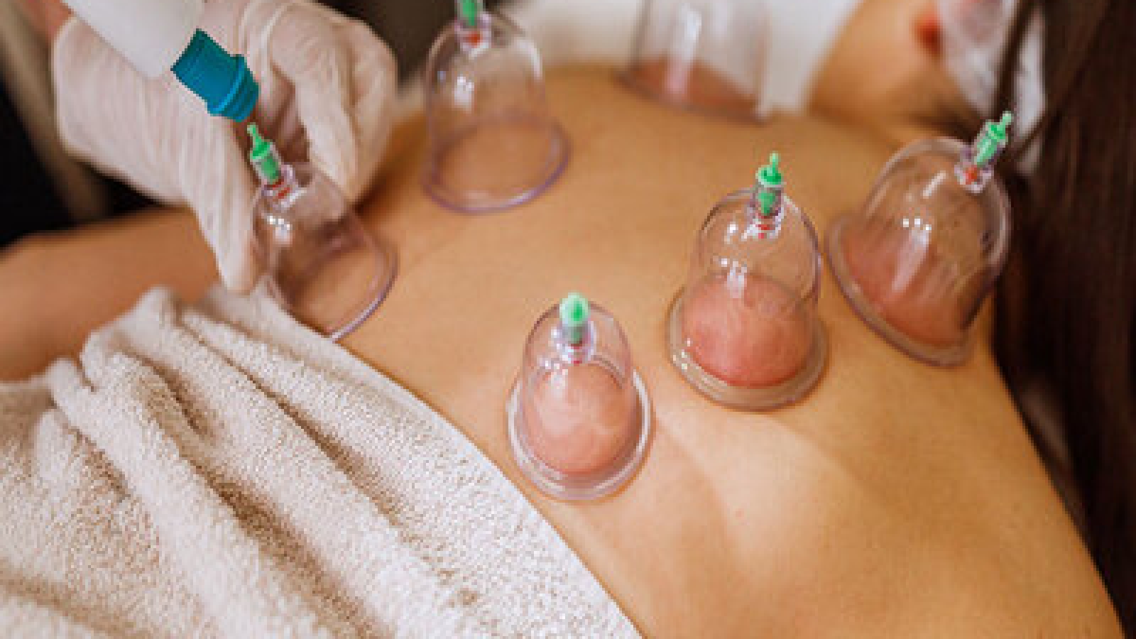 16554-cupping-therapy