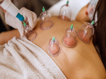 16554-cupping-therapy